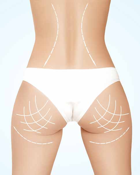 izmir kalça estetiği